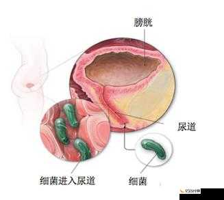 早上尿道口挤出黄脓：探究这一异常症状的原因与应对策略